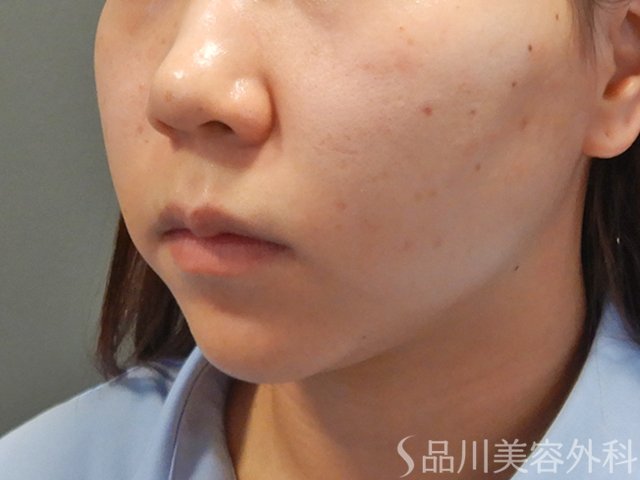 症例NO.74986のBEFORE写真