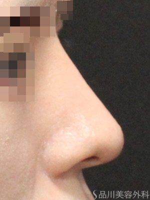 症例NO.75215のAFTER写真
