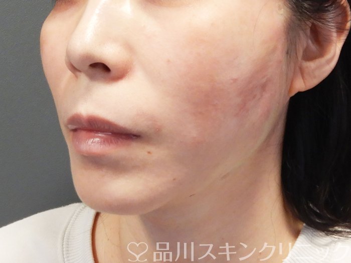 症例NO.74687のAFTER写真