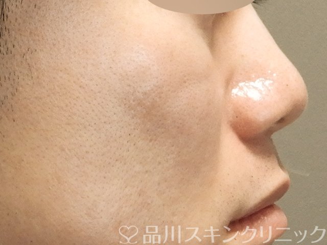 症例NO.68052のAFTER写真