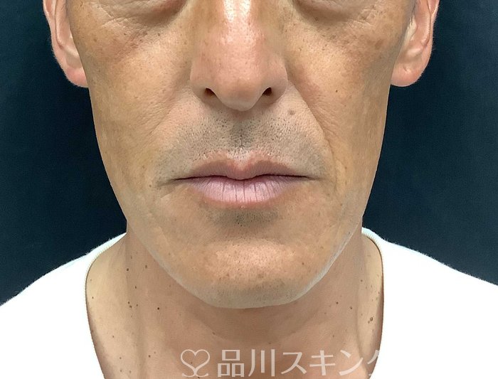 症例NO.71042のBEFORE写真