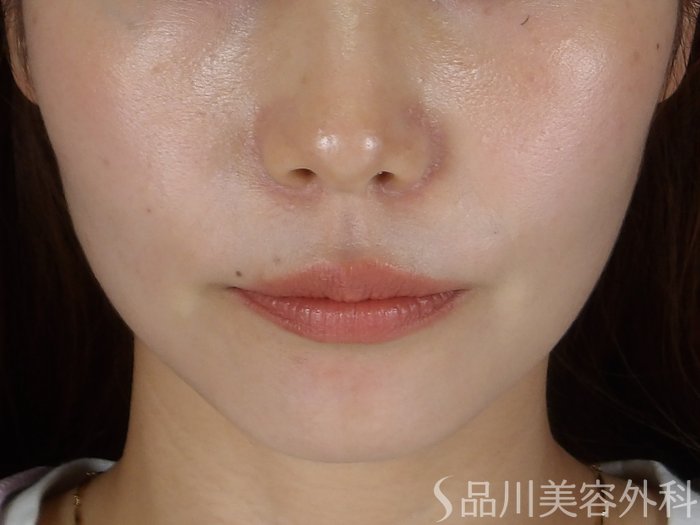 症例NO.71209のBEFORE写真