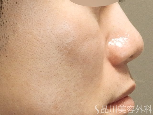 症例NO.68052のAFTER写真