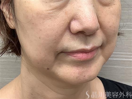 症例NO.55200のBEFORE写真
