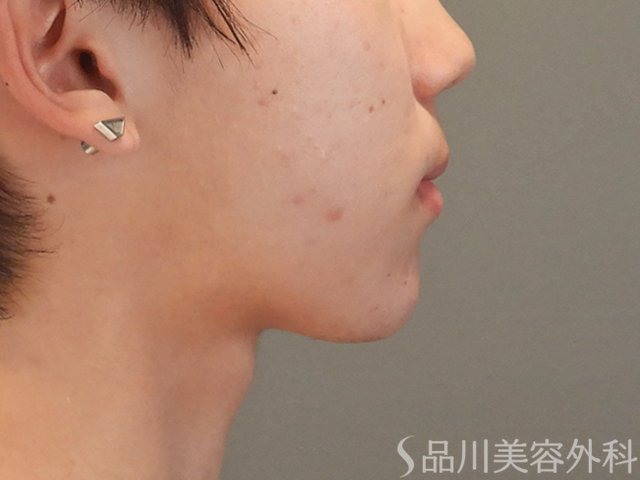 症例NO.74901のAFTER写真