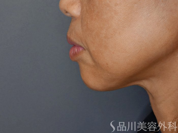 症例NO.71308のBEFORE写真