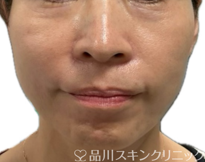 症例NO.71156のBEFORE写真
