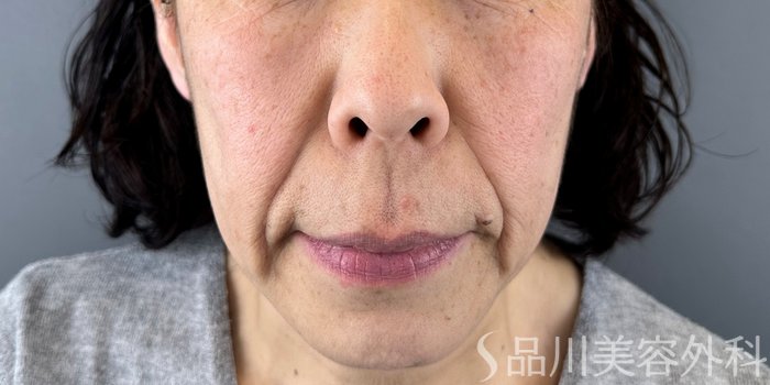 症例NO.72554のBEFORE写真