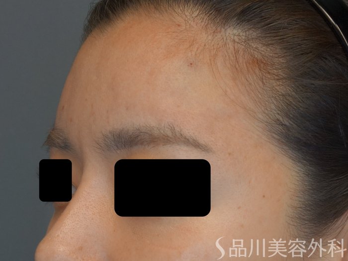 症例NO.74041のAFTER写真