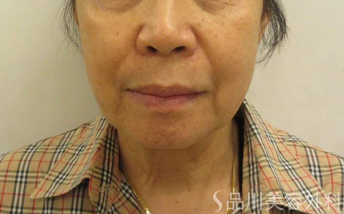 症例NO.71157のBEFORE写真