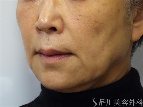 症例NO.40102のAFTER写真