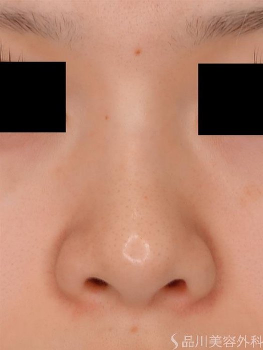 症例NO.54364のBEFORE写真
