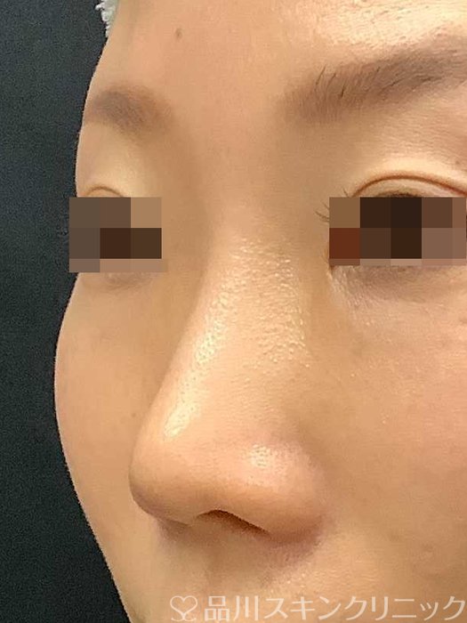症例NO.69703のBEFORE写真