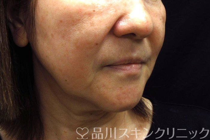 症例NO.74558のBEFORE写真