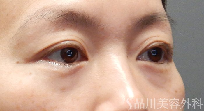 症例NO.70688のBEFORE写真