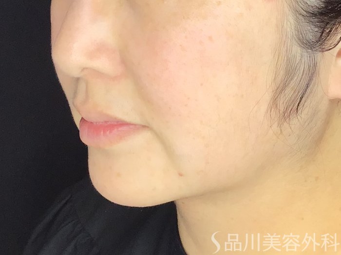 症例NO.68020のBEFORE写真