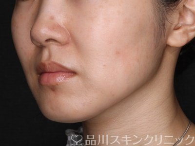 症例NO.73441のAFTER写真