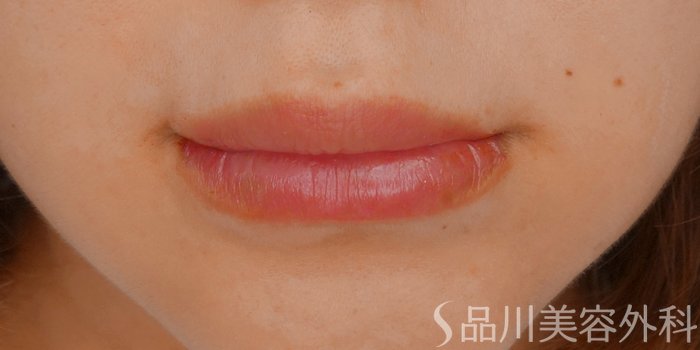 症例NO.71541のAFTER写真