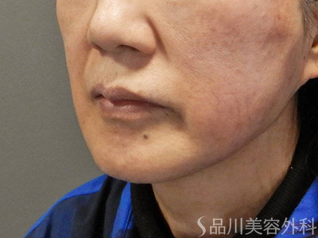 症例NO.73096のAFTER写真