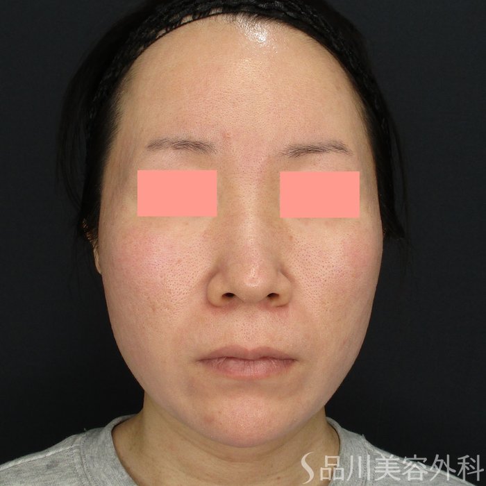 症例NO.73262のBEFORE写真