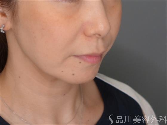 症例NO.52651のBEFORE写真