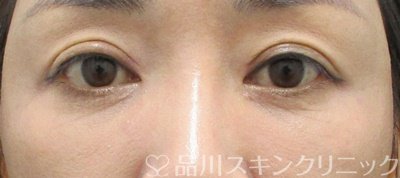 症例NO.65713のAFTER写真