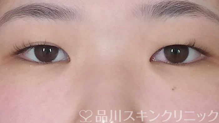 症例NO.71942のBEFORE写真