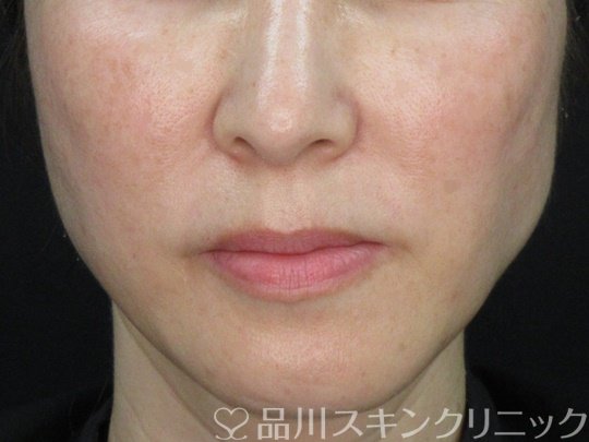 症例NO.72528のBEFORE写真