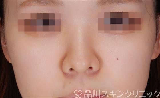 症例NO.56326のAFTER写真