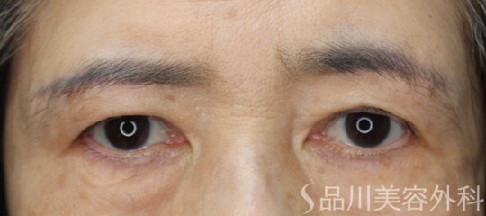 症例NO.74478のAFTER写真