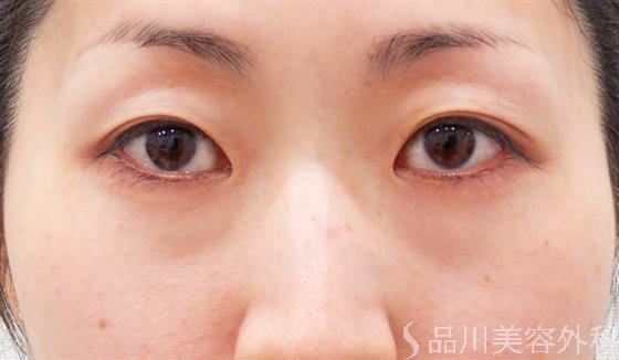 症例NO.60627のBEFORE写真
