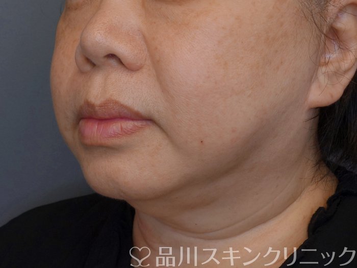 症例NO.74446のBEFORE写真