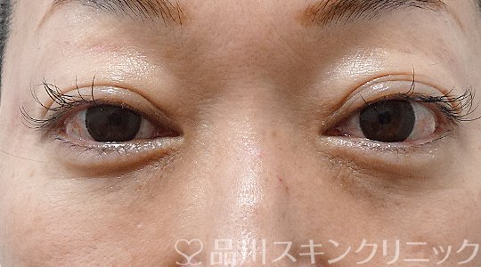 症例NO.62928のAFTER写真