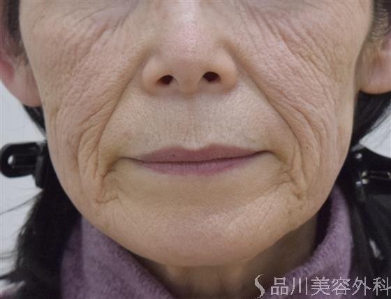 症例NO.50857のBEFORE写真