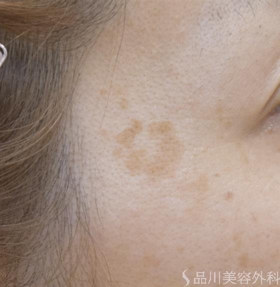 症例NO.48521のBEFORE写真