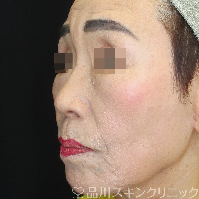症例NO.74230のBEFORE写真