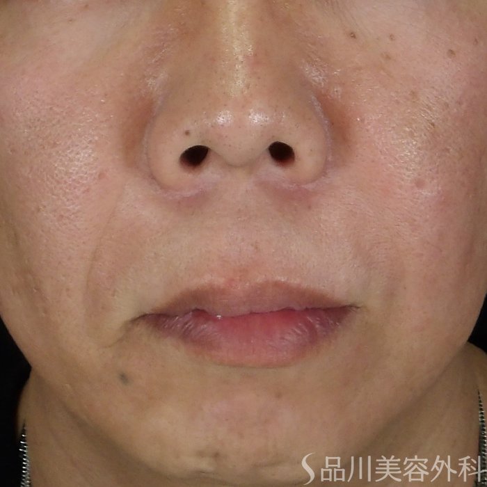 症例NO.69697のBEFORE写真
