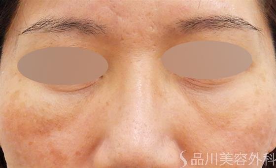 症例NO.61562のAFTER写真