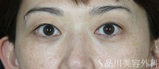 症例NO.62164のAFTER写真