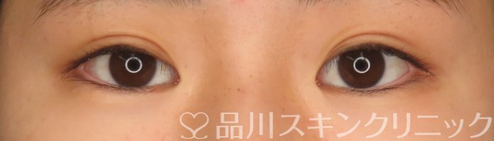 症例NO.65859のAFTER写真