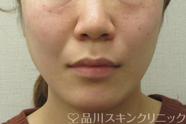 症例NO.74445のAFTER写真