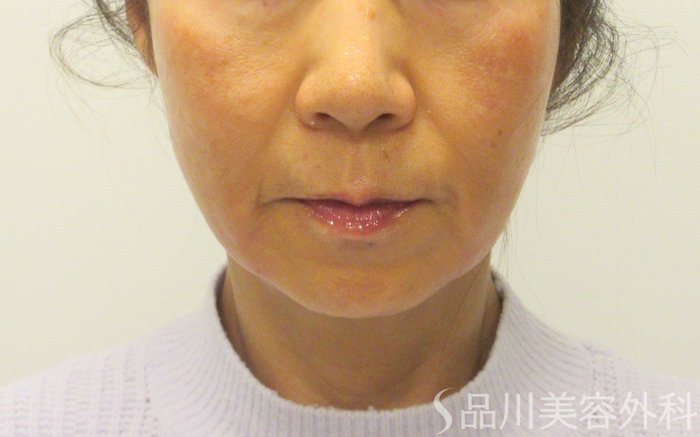 症例NO.73409のAFTER写真