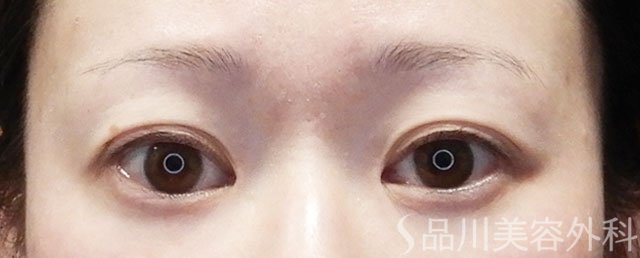 症例NO.73107のBEFORE写真