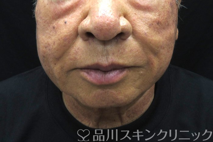 症例NO.74884のAFTER写真