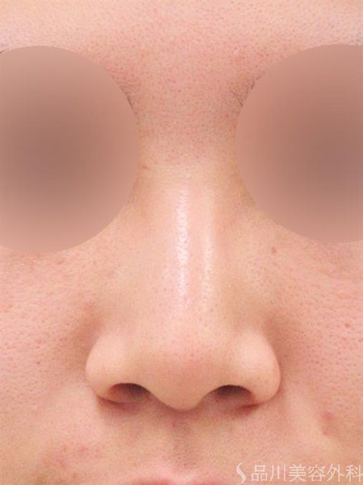 症例NO.22692のBEFORE写真