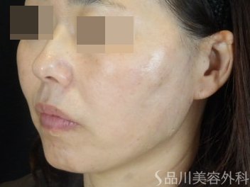 症例NO.74701のAFTER写真