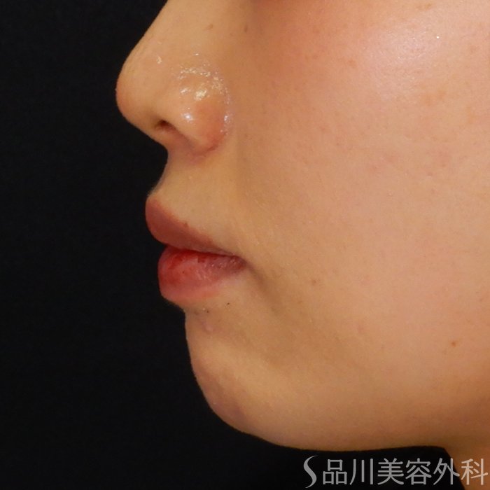 症例NO.67995のBEFORE写真