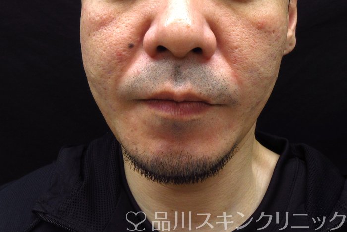 症例NO.74545のAFTER写真