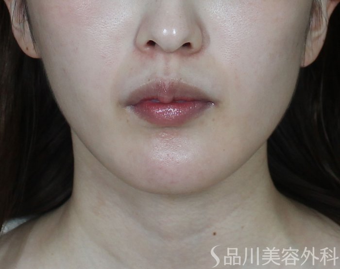 症例NO.73434のBEFORE写真