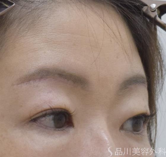 症例NO.52697のAFTER写真